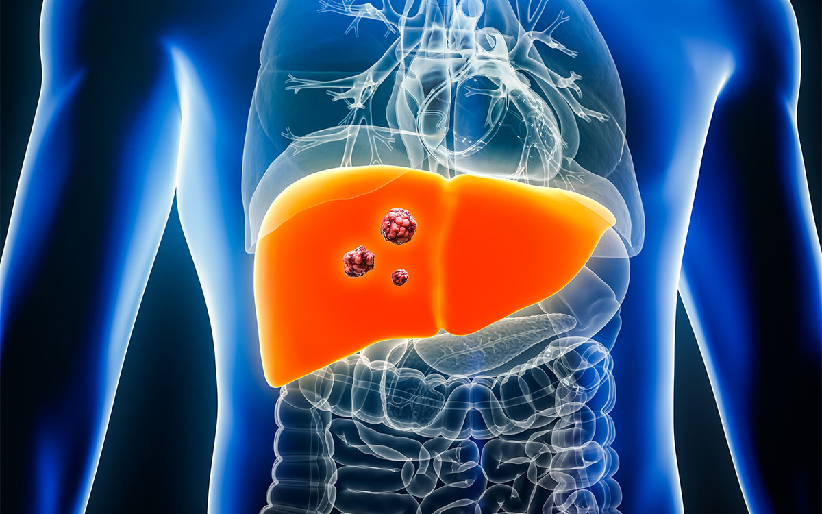 Stopping Liver Cancer Before It Starts - InventUM