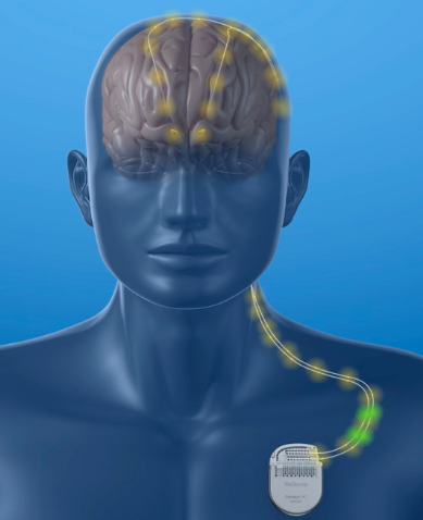 UHealth Neurosurgeon Implants Latest Two-way Deep Brain Stimulation ...