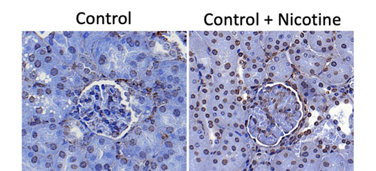 Nicotine Can Damage Kidney Cells in Smokers According to New