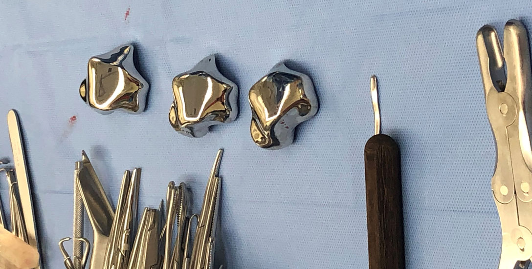 UM Surgeons Replace Ankle Bone with 3D-Printed Metallic Implant