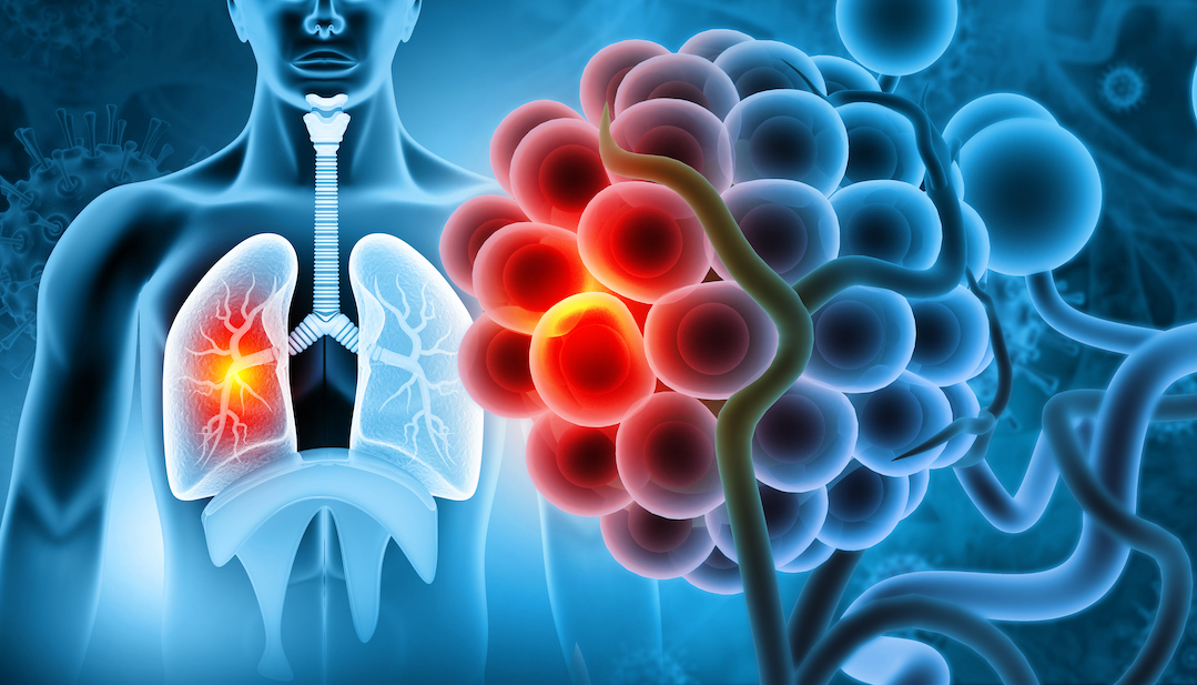 Program Reduces Opioid Dependence in Lung Cancer Patients - InventUM