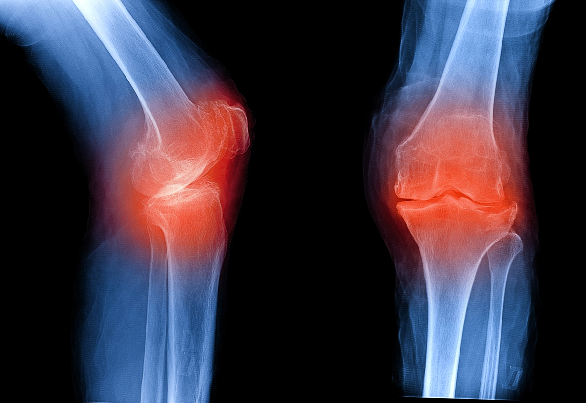 Miller School Radiologist Secures FDA Approval to Study Knee