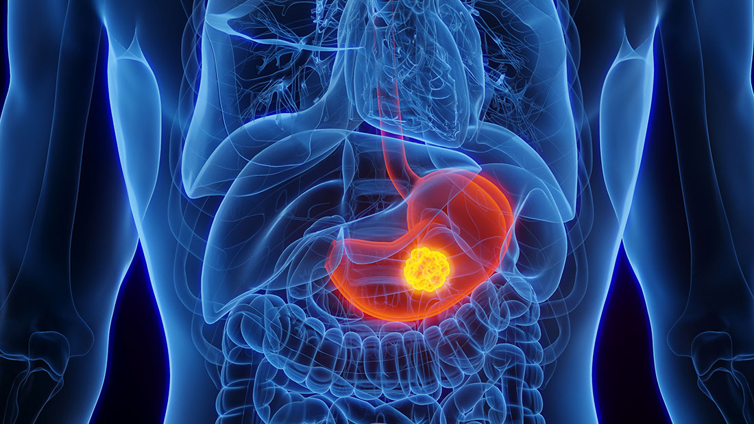 What If We Could Eliminate a Major Gastric Cancer Risk Factor? - InventUM