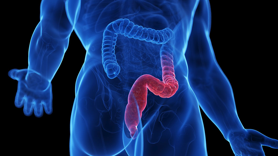 Hyperbaric Oxygen Therapy for Ulcerative Colitis - InventUM